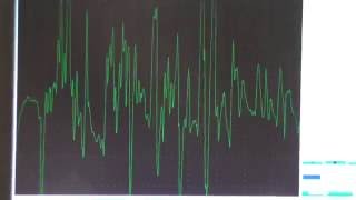 Myopathy EMG changes explained [upl. by Alethea]