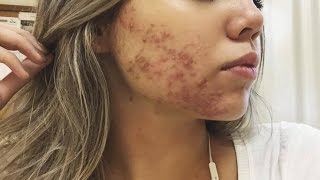 O que eu usei para tratar a acne Antibiótico Ácido Protetor solar e etc [upl. by Arinayed502]