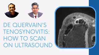 DE QUERVAINS TENOSYNOVITIS HOW TO SCAN ON ULTRASOUND [upl. by Sivert35]