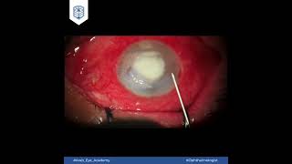 Educational Video 35 Intracorneal stromal injection [upl. by Raamaj]