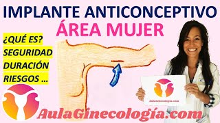 IMPLANTE ANTICONCEPTIVO ¿QUÉ ES SEGURIDAD DURACIÓN RIESGOS  Ginecología y Obstetricia [upl. by Leelaj]