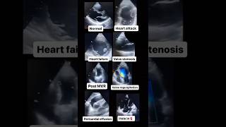 Echocardiogram NORMAL vs ABNORMAL radiology cardiology [upl. by Hainahpez]