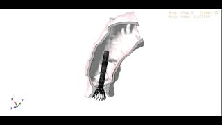 Medtronic CoreValve simulation [upl. by Necyla]