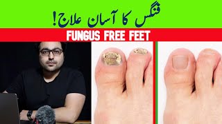 Dr ZeeGet Rid Of Toenail Fungus A complete guide [upl. by Rodina]