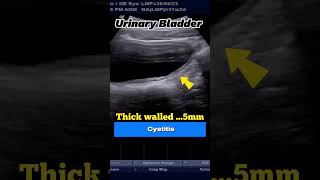 Ultrasound Cystitis of 21yrs Boy with Residual Urine [upl. by Mullins]