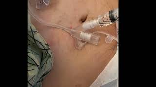 Removing and inserting a Gastrostomy Tube [upl. by Ettener167]