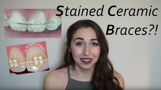 STAINS IN CERAMIC BRACES Ways to clean them Wk2 Vlog  Adult Braces to Treat TMJTMD [upl. by Krista]