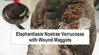 Elephantiasis Nostras Verrucosas and Wound Maggots [upl. by Bramwell]