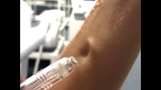 OXYGEN JET PEELING with Zemits Oxy Meso Prof [upl. by Battiste290]