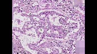 Histopathology Lung Adenocarcinoma [upl. by Boris967]