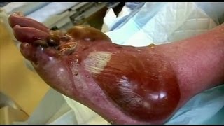 Pus Filled Blisters  Bizarre ER [upl. by Laenej572]