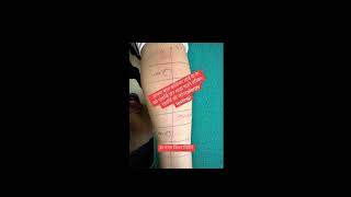 Allergy Test Dr Jagat jeevan Ghimire swasthyapharmacy allergytesting shortsvideo shorts [upl. by Pettiford]