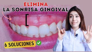 La Solución Definitiva para la Sonrisa Gingival gummysmile [upl. by Aistek864]