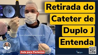 Como Retiramos o Cateter de Duplo J  O que todo mundo deveria saber antes da cirurgia [upl. by Pesek]