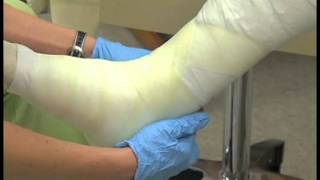 Putting On a Cast  Medical Assistant Skills Video 8 [upl. by Cohleen]