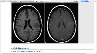 TOP 3 DIFFERENTIALS IN NEURORADIOLOGY [upl. by Ecnatsnoc126]