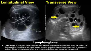 Spleen Ultrasound Reporting  Splenic Disease Scan Reports  How To Write USG Report  Abdominal USG [upl. by Meerek]