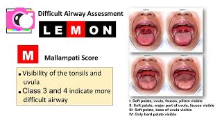 Lemon Criteria for Difficult Airway Assessment [upl. by Ambrosio]