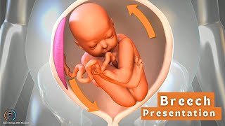 Breech presentation  Feet down baby position [upl. by Alurta613]