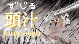 No164「頭汁」浸出液の溜り池  Exudate juicy scab  exudado costra jugosa  滲出多汁痂  육즙이 많은 딱지가 삼출됩니다 [upl. by O'Neill]