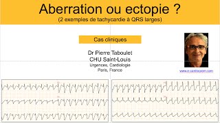 10c Quiz tachycardie à QRS larges TV  A B A et B ni A ni B P Taboulet [upl. by Korey974]