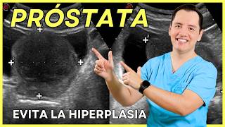 🚨 Diagnóstico de la HIPERPLASIA PROSTÁTICA BENIGNA Síntomas Factores de Riesgo y Ecografía 🚨 [upl. by Ewall81]