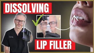 Dissolving Lip Filler  How to use Hyaluronidaise  Filler Reversal [upl. by Wearing]