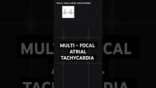 multifocal atrial tachycardia  ECG basics [upl. by Anib]