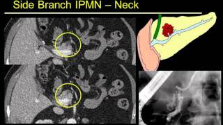 Lesiones quisticas del pancreas evaluación con RM Dr Jorge Soto [upl. by Kellyann476]