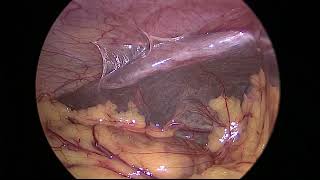 Right salpingectomy for unruptured tubal ectopic pregnancy [upl. by Ahseniuq]