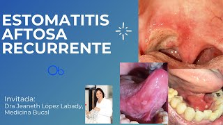 Estomatitis aftosa recurrente 👄 👅 [upl. by Lowson]