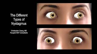 Types of Nystagmus Due to BPPV Vertigo What it Looks Like Which Side amp Which Maneuver [upl. by Schumer]