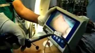 Glidescope intubation [upl. by Acirretal]