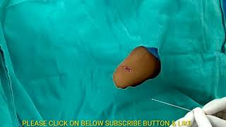 Lumbar Puncture Procedure in Hindi spinal tap diagnostic Procedure [upl. by Neerod]