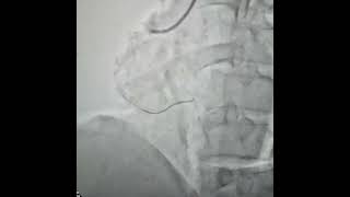 Angioplasty and Stenting to RCA with 2 Stents  Agra Heart Center  Heart Stent Surgery Video [upl. by Mogerly]