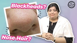 Nose Hair or Blackheads  How to Remove Nose Hair  Trichostasis Spinulosa [upl. by Naerb]