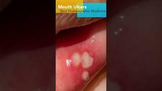 Mouth Ulcer  2 Drop 2 times a day  Best Homeopathic Medicine  How to Use [upl. by Zetnas]