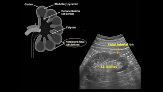 Fetal lobulation of kidney 신장의 태아 분엽 [upl. by Campbell381]