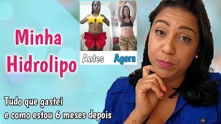 HIDROLIPO  VALORES E COMO ESTOU 6 MESES DEPOIS  Parte 3 [upl. by Ailehc]