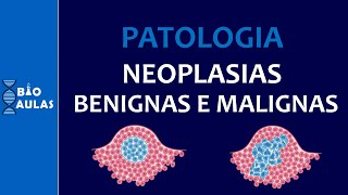 Neoplasias Benignas e Malignas  Características Nomenclatura e Diferenciação Patologia Geral [upl. by Karna]