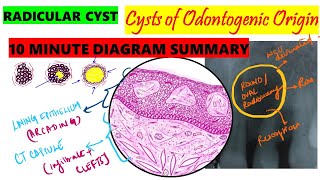 Radicular Cyst 10 MINUTE SUMMARY HISTOPATHOLOGY  Clinical features  Etiopathogenesis  Oral path [upl. by Adnauqaj]