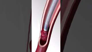 How Blood Clots Are Removed  3d animation bloodclotting stroke vascularsurgery thrombectomy [upl. by Ogilvie]