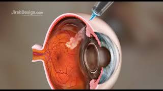 Intravitreal Injection Animation HD [upl. by Yenalem]