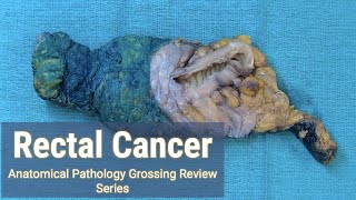 Rectal Cancer  Lymph Node Hunt  Anatomical Pathology Grossing Review Series [upl. by Aicnom]