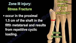 Proximal Fifth Metatarsal Fractures  Everything You Need To Know  Dr Nabil Ebraheim [upl. by Draude564]