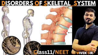 Disorders of Skeletal System  Disorders of Muscular amp Skeletal System  Class 11 Biology NEET [upl. by Gay]