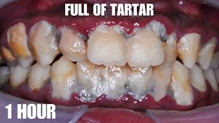 SCALING  SATISFYING  TARTAR  Dentist  Dokter Gigi Tri Putra [upl. by Souvaine]