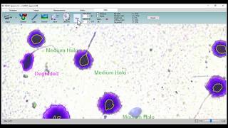 MMC Sperm DNA fragmentation analysis [upl. by Farrish478]