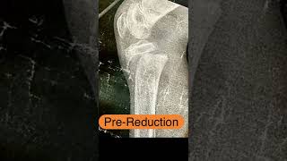 Close reduction of proximal epiphyseal slip of tibia in kids  SALTERHARRIS type 1 [upl. by Normand]