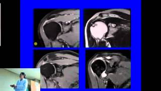 Resonancia Magnética Nuclear en Hombro [upl. by Fabrin406]